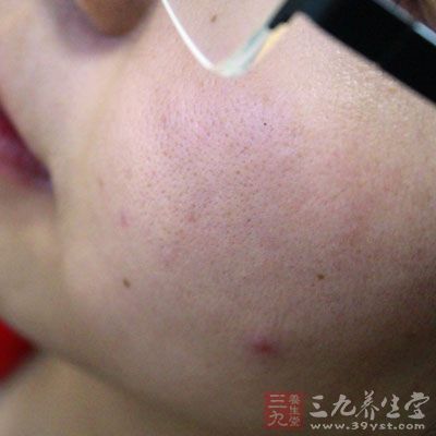 因胃肠机能失调而引起的痤疮