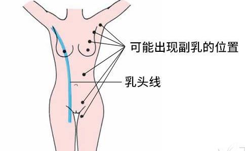 副乳是什么 副乳怎么消除 副乳图片
