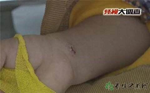 多名学生手脚生疮 冬季孩子易感染哪些流行病