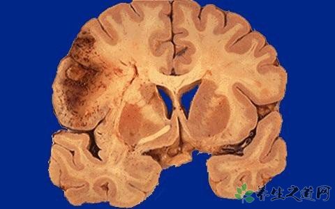 围观牌局险送命 患有脑梗死症需注意什么